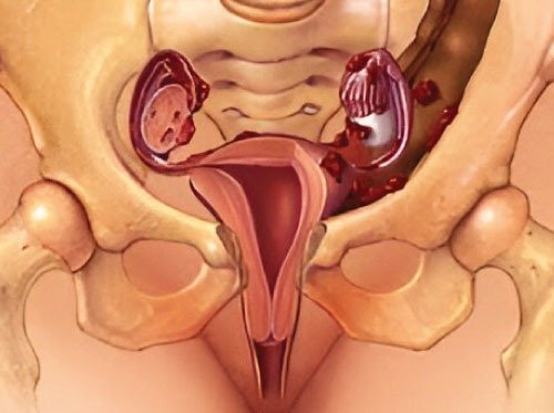 Pelvic Pain Management in Gynecology Patients